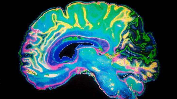 A coloured MRI scan of the human brain. 
